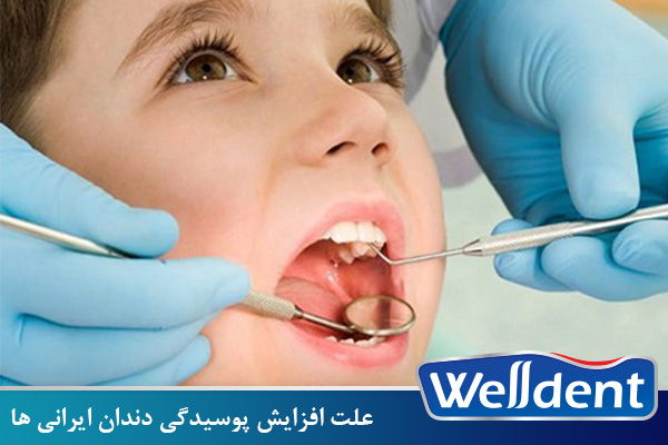 علت افزایش پوسیدگی‌ دندان ایرانی ها/ دومین بیماری عفونی شایع